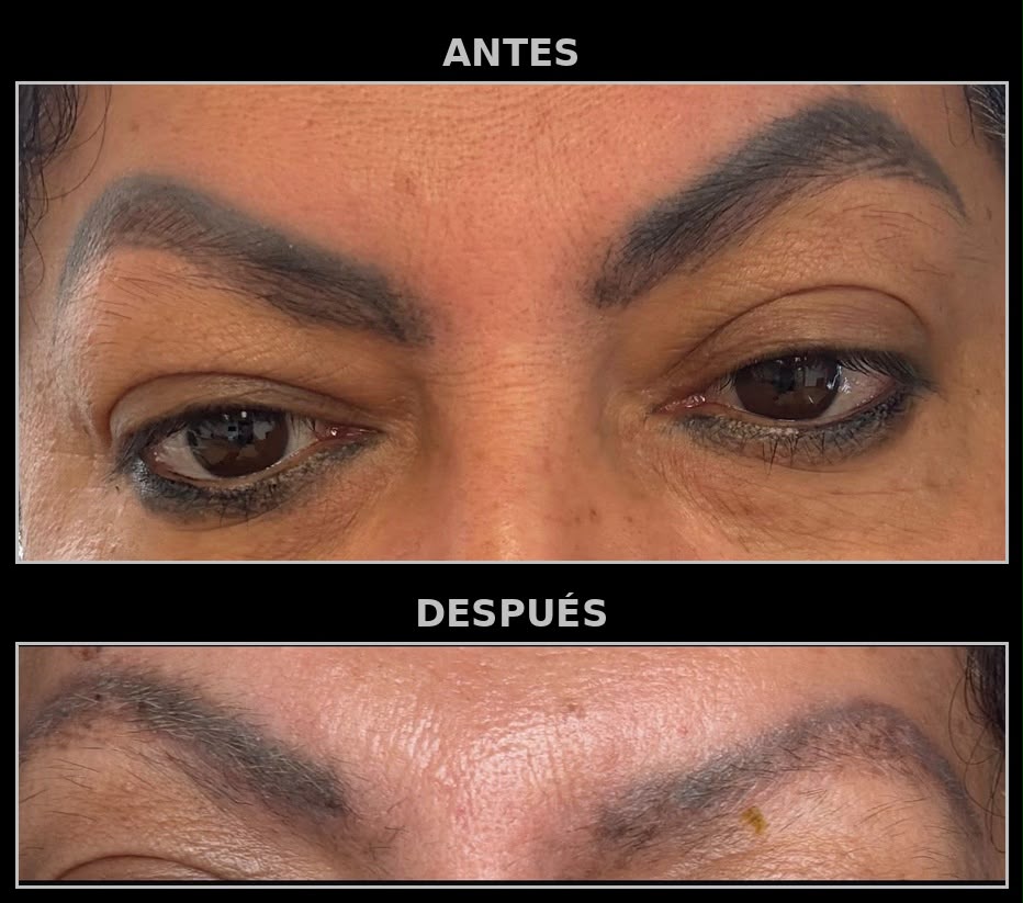 Eliminación de tatuaje en cejas con láser — LISALASH STUDIO